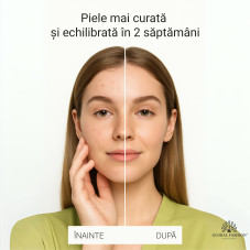 Ser cu ceai verde împotriva acneei, Global Fashion, Green Tea Serum Anti-Acne, 50 ml Ser cu ceai verde împotriva acneei, Global Fashion, Green Tea Serum Anti-Acne, 50 ml